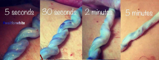 series of colour photos showing umbillical cord after 5 seconds, 30 seconds, 2 minutes and 5 minutes after birth